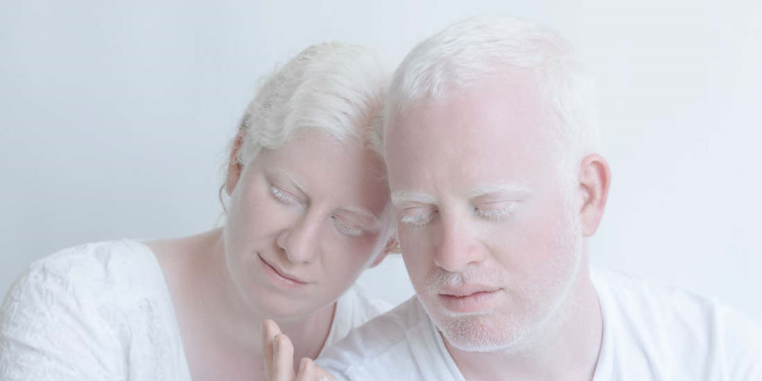 un hombre y una mujer albinos aparecen con los ojos cerrados